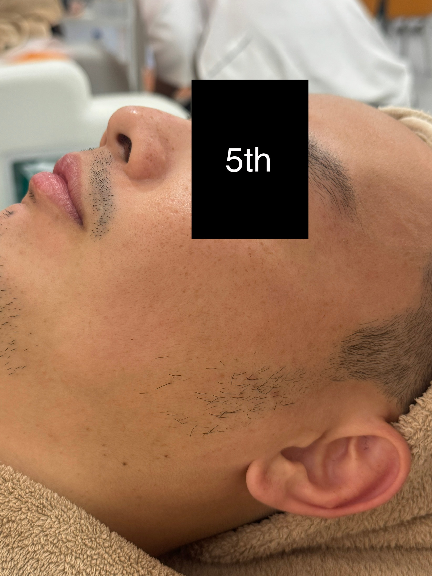 Enlarged Pores After