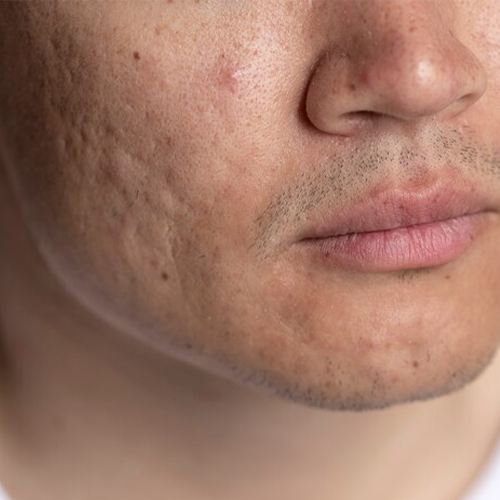 Acne Scars