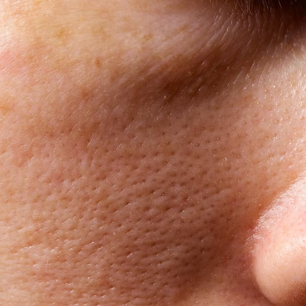 Enlarged Pores