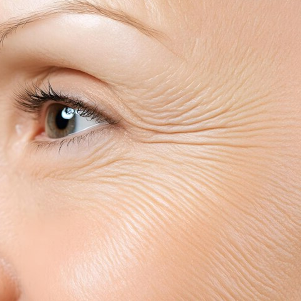 Fine Lines & Wrinkles