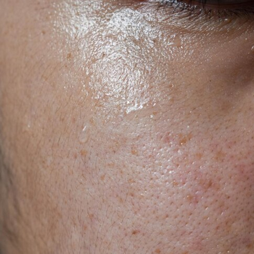 Oily Skin / Shiny T-Zone