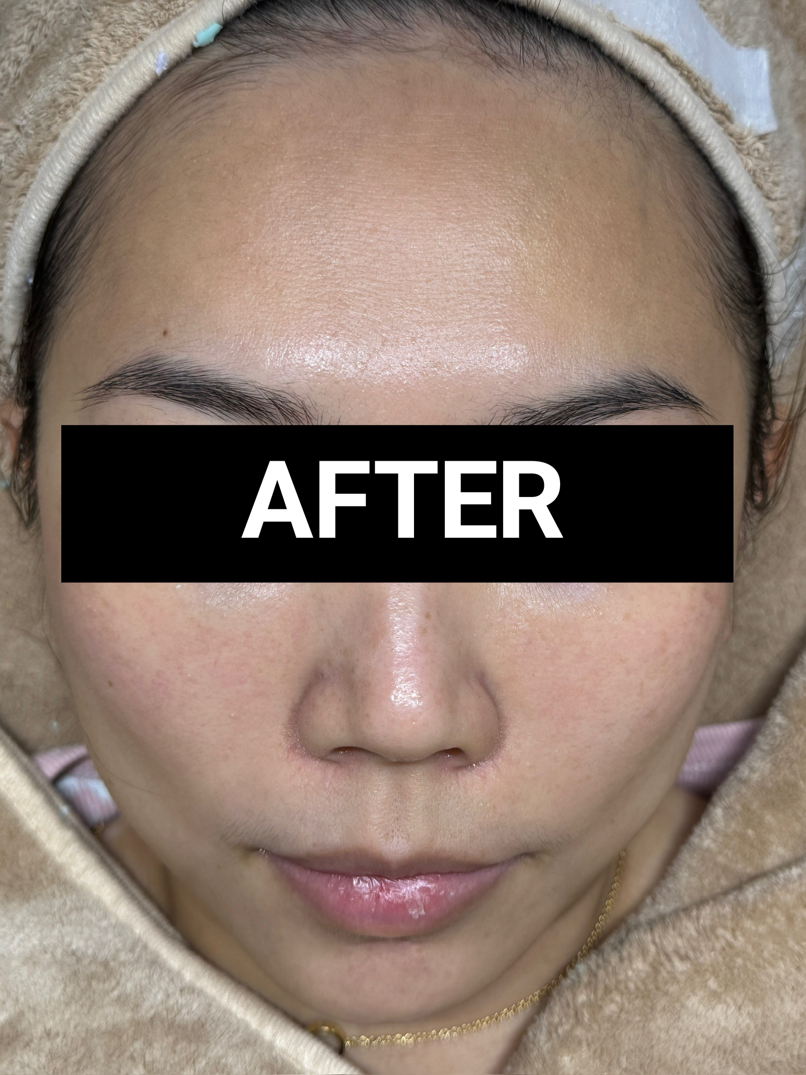 sensitive skin after