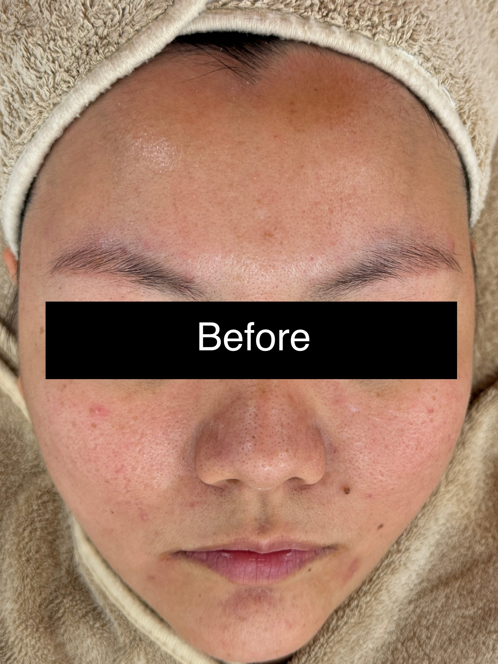 1 Dry & Dehydrated Before