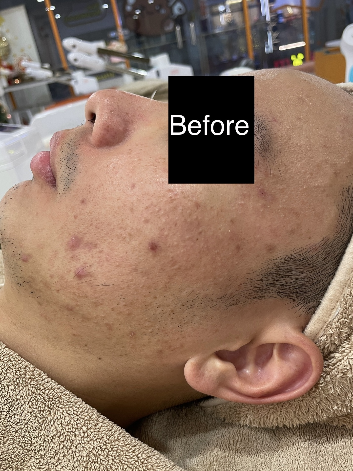 1 Enlarged Pores Before