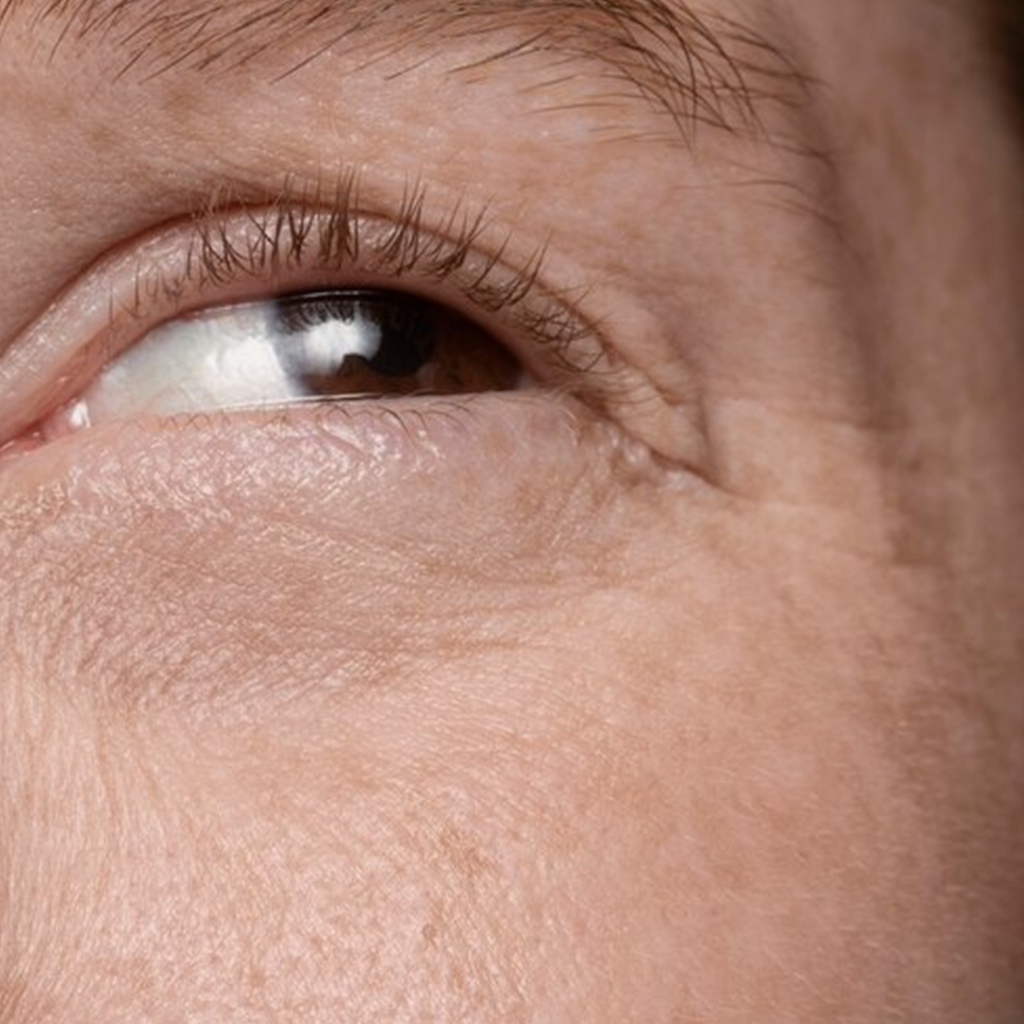 Crepey Under-Eye Skin