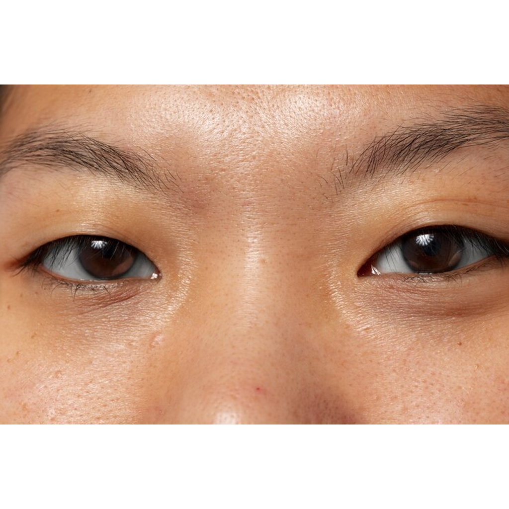 Dark Circles & Eye Bags Dark Circles & Eye Bags