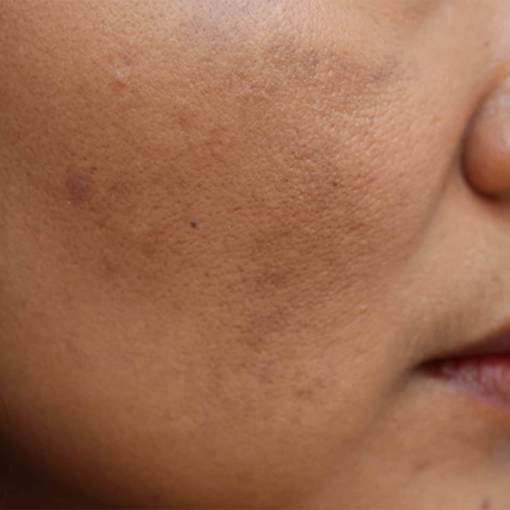 Dull & Uneven Skin Tone