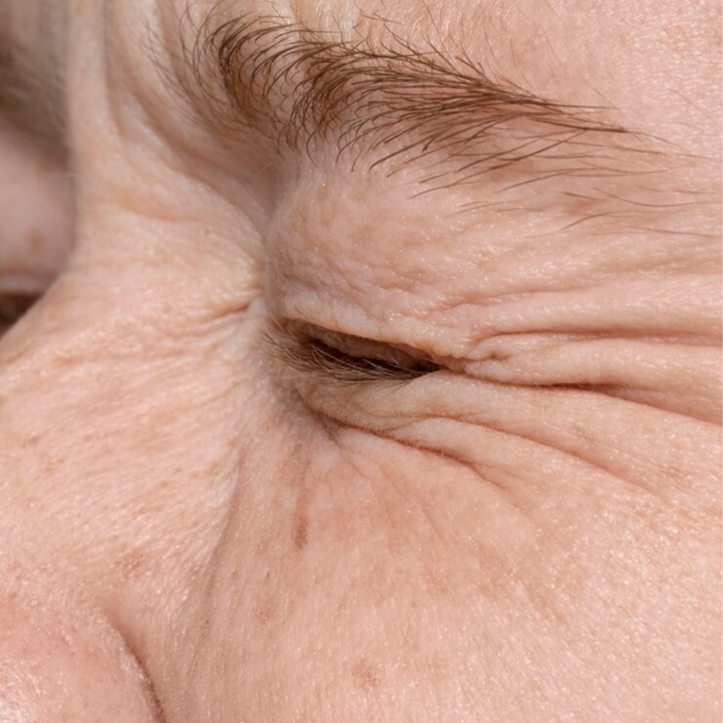 Eye Wrinkles Fine Lines at Eyes