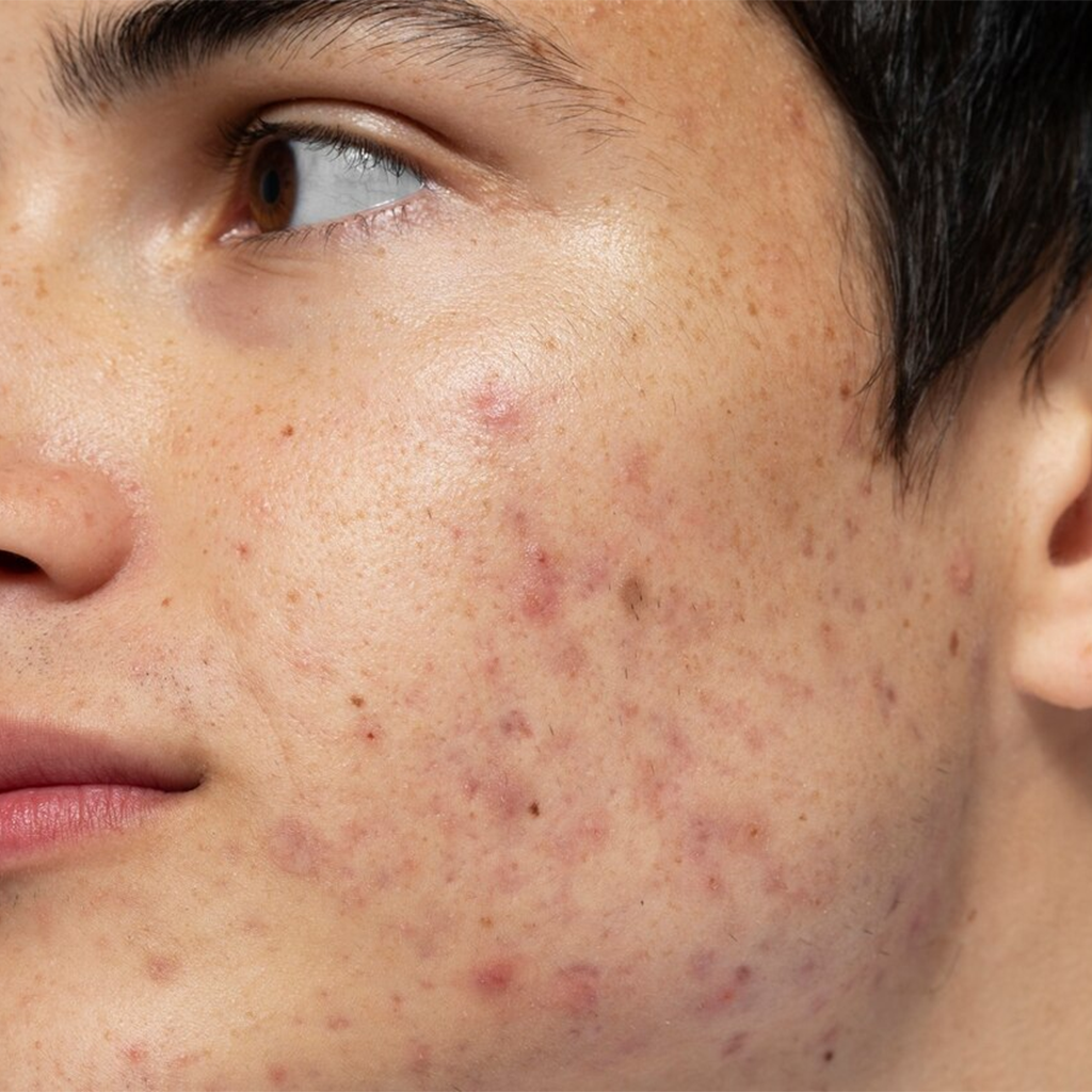 Steroid-Induced Acne Steroid-Induced Acne