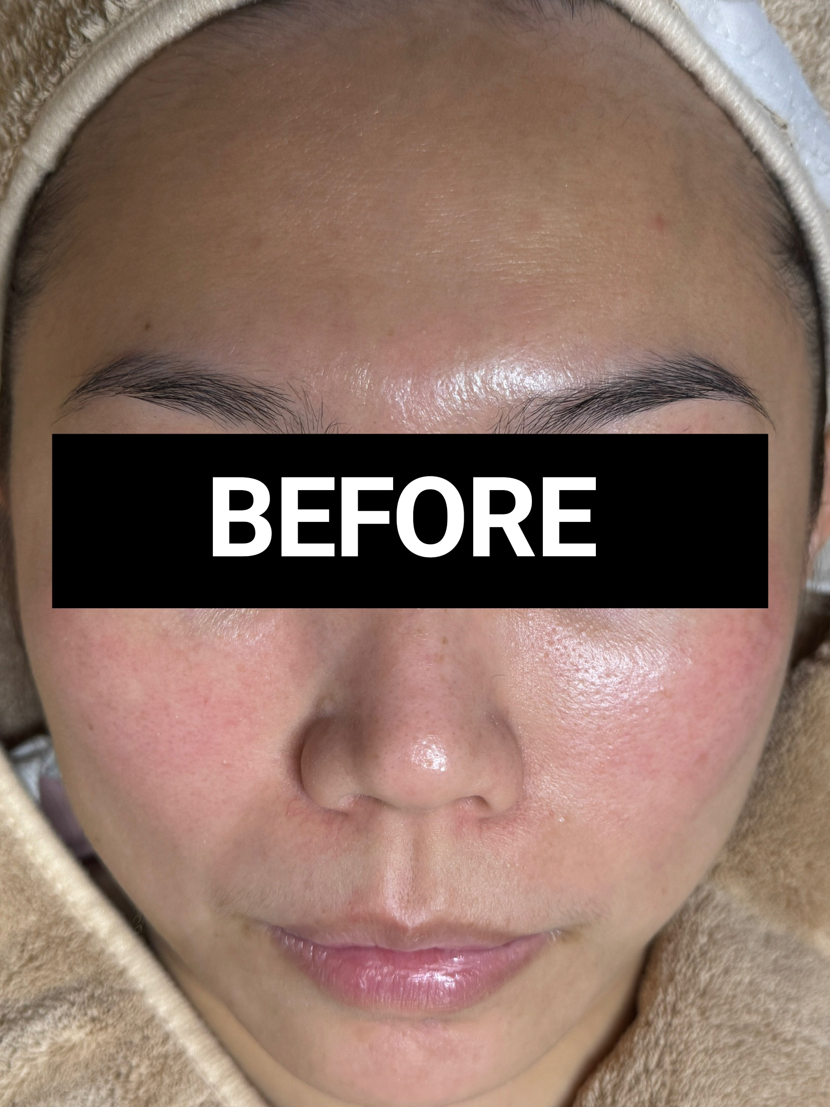 sensitive skin before