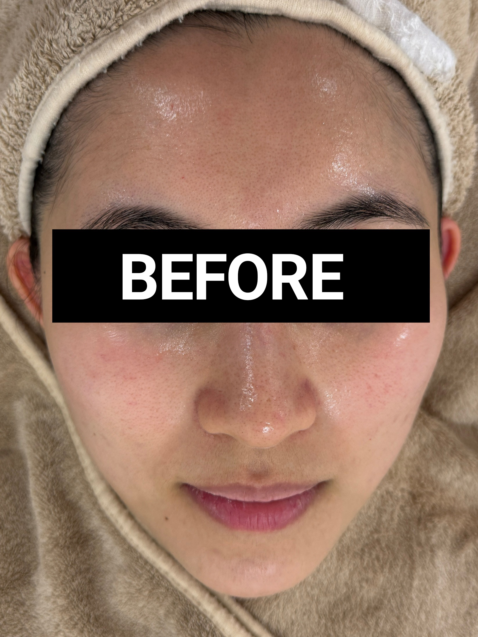 uneven skin before uneven skin before