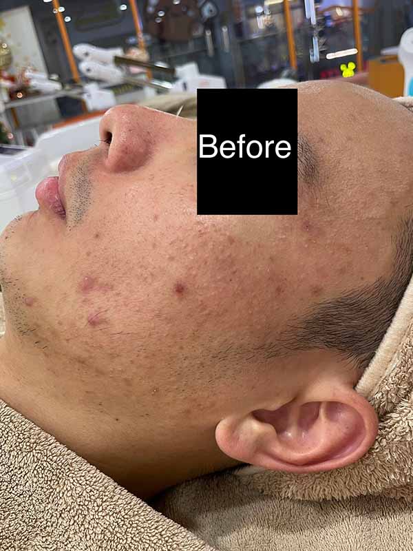 Before Combination Treatment