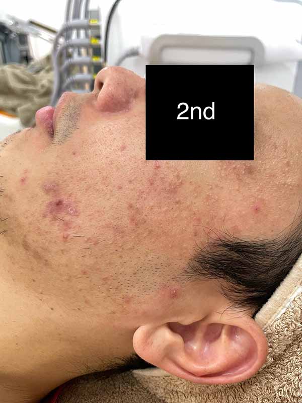 2nd Combination Treatment