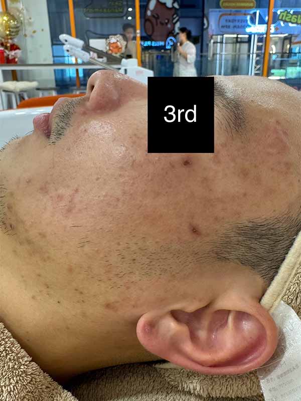 3rd Combination Treatment