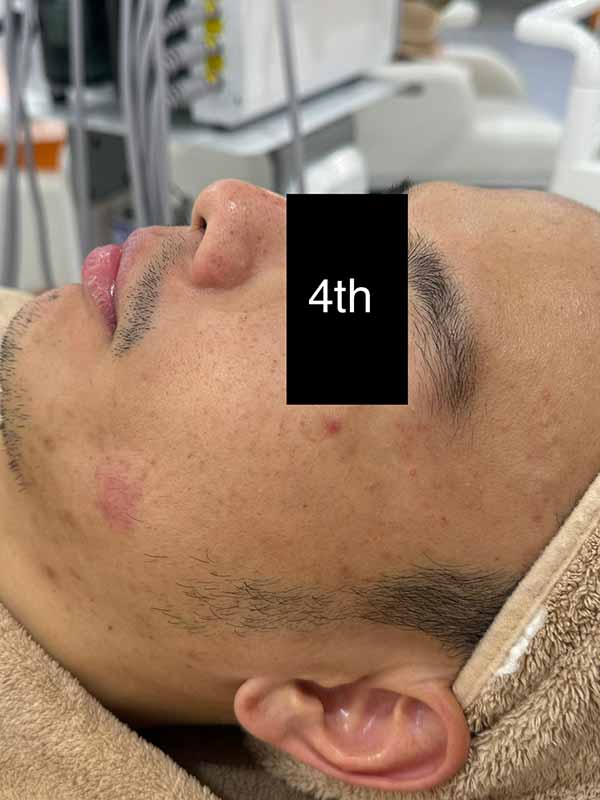 4th Combination Treatment