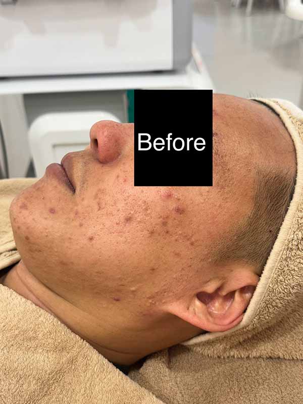 Before Enlarged Treatment