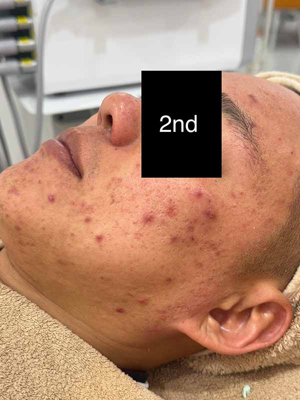 2nd Enlarged Treatment