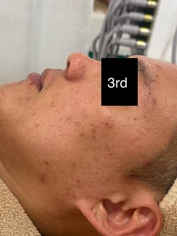 3rd Enlarged Treatment