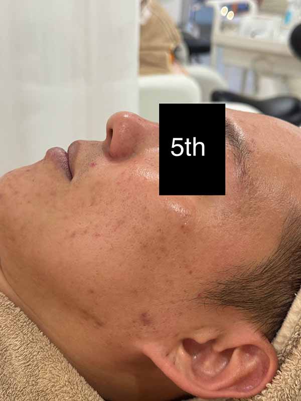 5th Enlarged Treatment