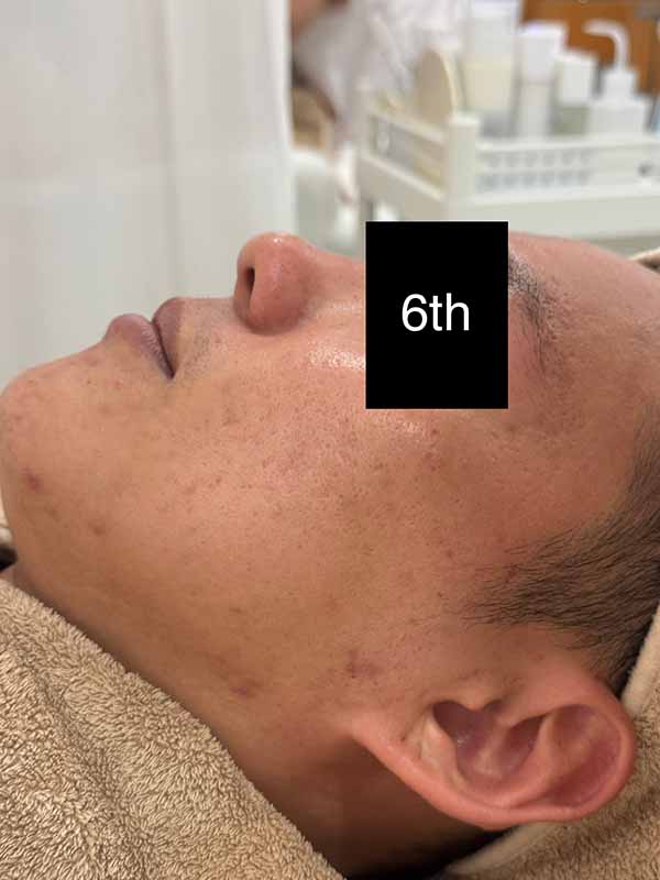 6th Enlarged Treatment