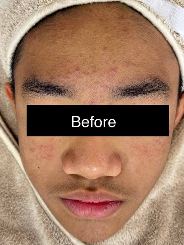 Before Mild Treatment