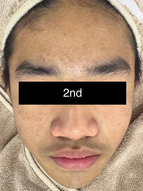 2nd Mild Treatment