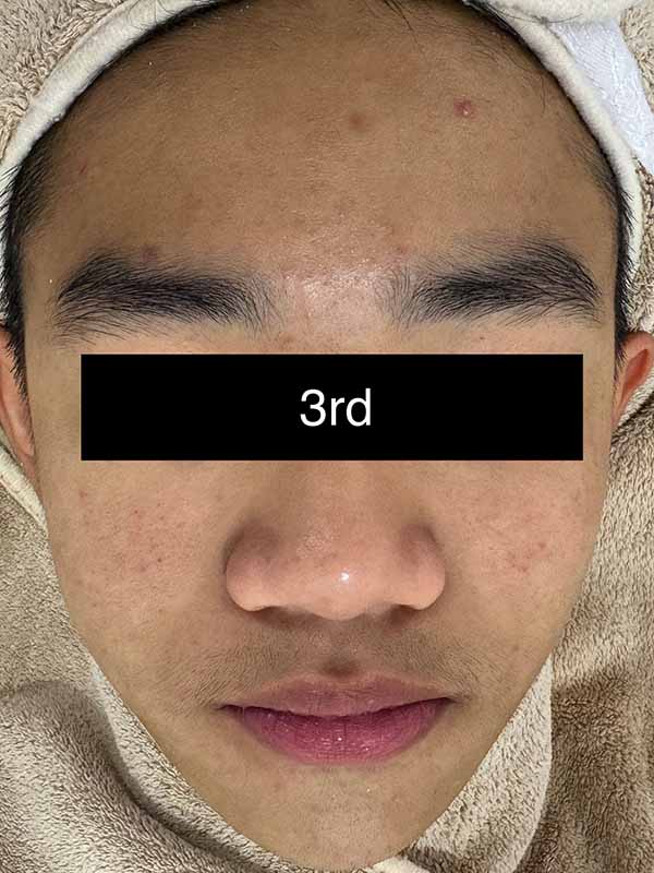 3rd Mild Treatment