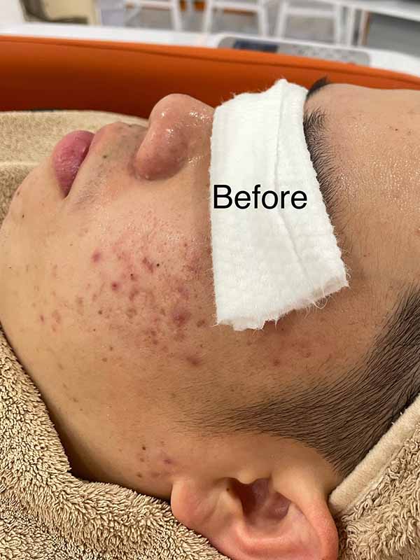 Before Oily Treatment