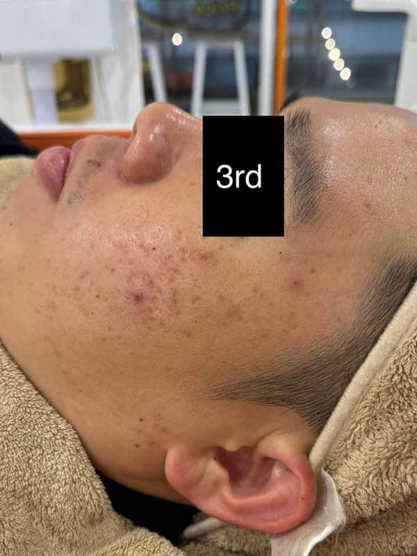 3rd Oily Treatment