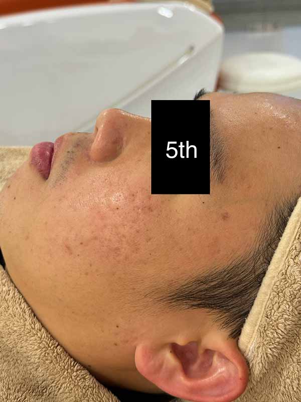 5th Oily Treatment