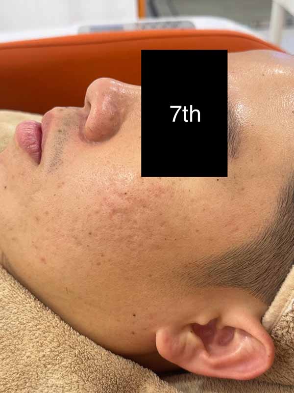 7th Oily Treatment