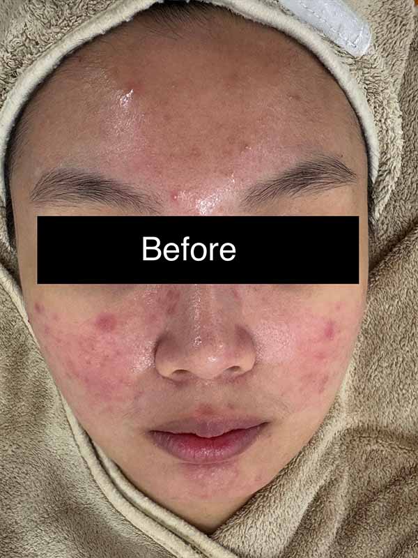 Before Sensitive Treatment