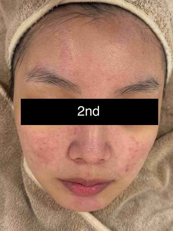 2nd Sensitive Treatment