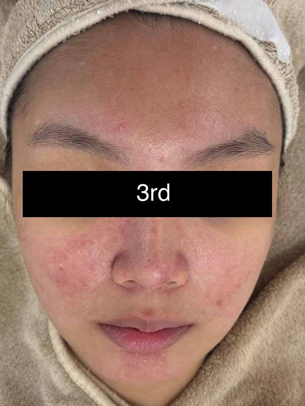 3rd Sensitive Treatment