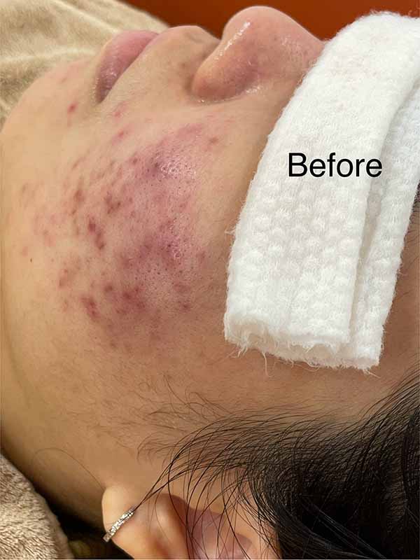 Before Severe Treatment