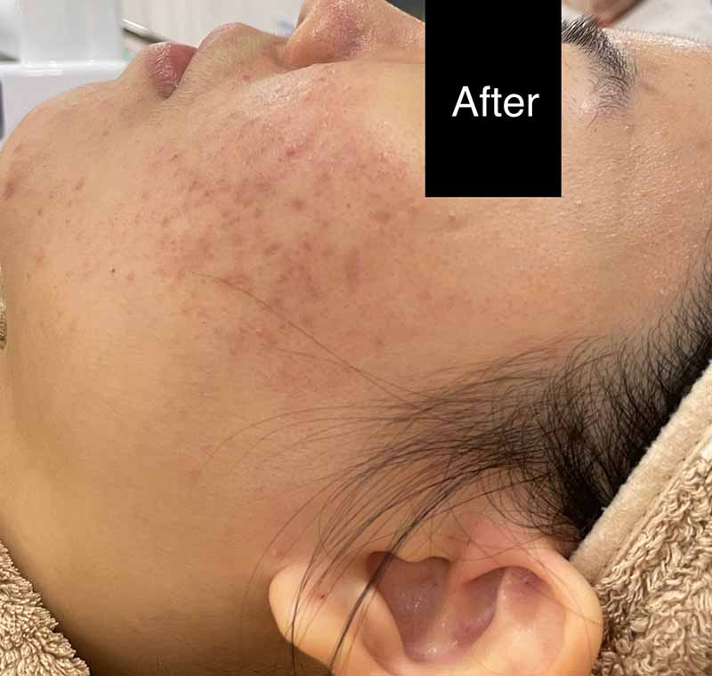 After Severe Treatment